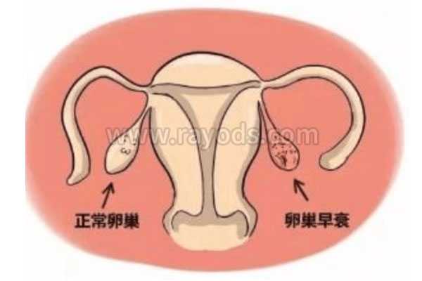 女人月经提前是卵巢早衰的症状吗？也许是这3种病在提醒你